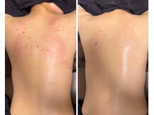 小顔アンドエイジングケア専門店 ビゼ(美sser)/REVIハーブピーリング