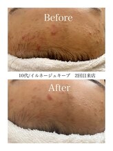 パーソナルスキンケアサロン 神戸 本山南/肌荒れの改善へ