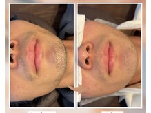 プルベル 平尾(Plus Belle)/ヒゲ脱毛