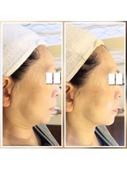 イーオ(io)/フェイスラインすっきり！