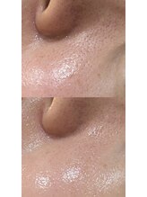 リラ(Lilas)/毛穴の開きがきになったら