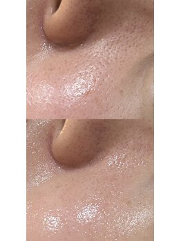 リラ(Lilas)/毛穴の開きがきになったら