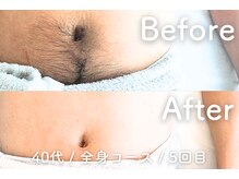 ユング 渋谷店(YUNG)/【腹脱毛】ギャランドゥ脱毛