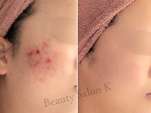 ケイ(K)/《頬ニキビ》肌質改善コース