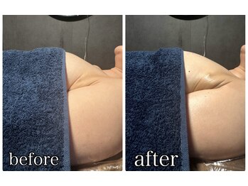 リルマコ/バスト症例写真