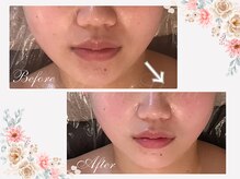 マリスステラ 天王寺(MarisStella)/肌改善小顔リフト80分初回の変化