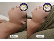 キラベル 平塚店(KiraBelle)/平塚/週1ハーブでニキビ改善