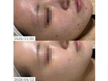 ルポ(RUPO)/ニキビケア（20代）