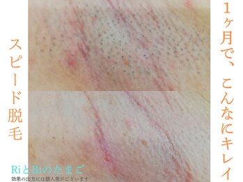 RiとBiのたまごの写真/【最短2週間に1回OK】肌をいたわりスピーディーに完了を目指す脱毛。　脱毛デビューにオススメ◎