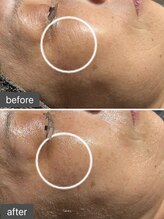 ロッタ エクリュ(Lotta ecru+)/REVIハーブピーリング