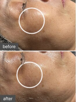 ロッタ エクリュ(Lotta ecru+)/REVIハーブピーリング