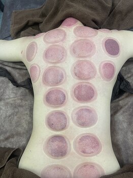 リベル(Liber)/ダイエットにもカッピング