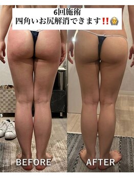 痩身革命 大宮店/施術写真(痩身)