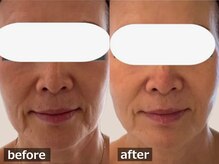 ココモンド(COCOMONDO)/幹細胞フェイシャル/エイジング