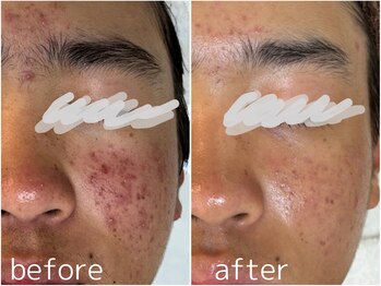 フォー(For...)/肌改善・ニキビケア◇ララピール