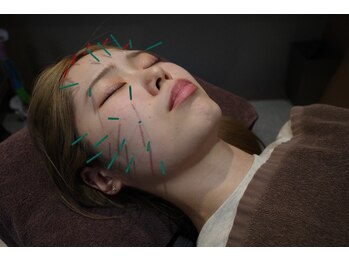 栄光治院 安城院/大人気の美容鍼♪