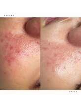 イチロクイチハチ(1618)/鎮静だけでなく保湿も