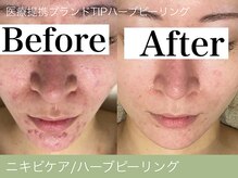 オーエン 小倉店(o-eN)/ニキビケア/ハーブピーリング