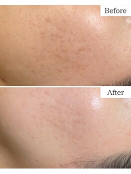 シャムリー(SHAMRY)/TROIAREUKE／スキンメイド