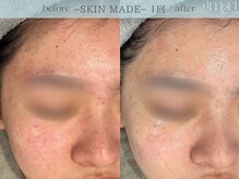 スキンラボアメリ(skin lab. ameri)/お悩み…ニキビ赤み敏感ざらつき