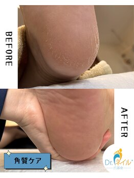 ドクターネイル爪革命 群馬両毛店/角質ケア