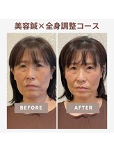 ベルソー鍼灸整体院(berceau鍼灸整体院)/【美容はり×根本改善】