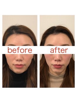 ジョア(joie)/美容鍼で小顔＆美肌