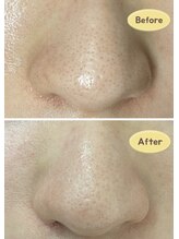 FJ/毛穴のお悩みに◎フェイシャル