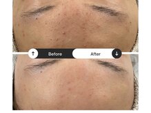 リジュ(Reje)/赤み&ニキビケア