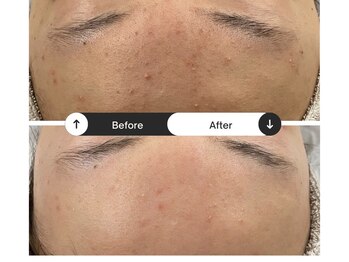 リジュ(Reje)/赤み&ニキビケア