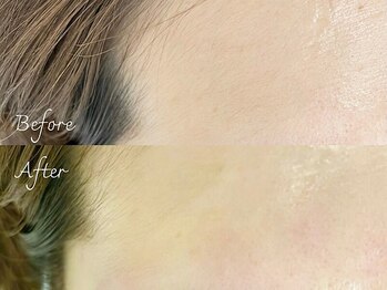 アンジェリック 上野マルイ店(Angelic)/額ワックス/ワックス脱毛