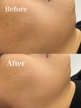 ツール(TOOL)/リフトアップ×プラズマ