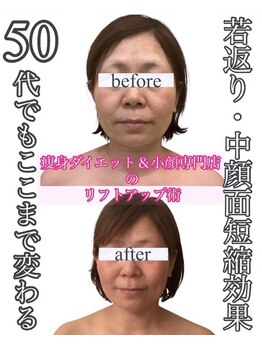 アールズ スリム(R's slim)/小顔専門店の効果！フェイシャル