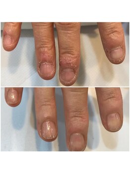 リーフ(Leaf)/爪だけでなくてのお悩みも