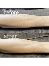 ムート(Mut.)/メンズ脱毛／腕