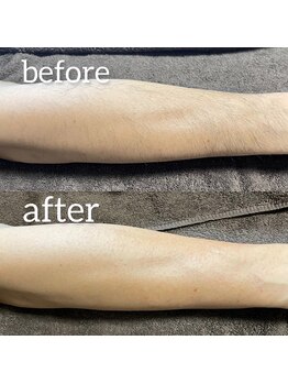 ムート(Mut.)/メンズ脱毛／腕