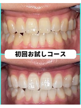 ホワイトニングビューティー 吉祥寺店/ホワイトニング 初来店
