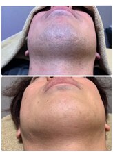 ディア 金町店(Dear)/青ヒゲ卒業！第一印象改善◎