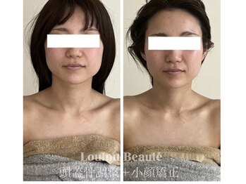 ルルボーテ(Loulou Beaute)/頭蓋骨調整+小顔矯正