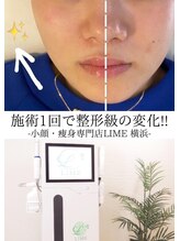 ライム 大宮(LIME) Vライン 形成