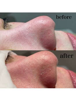 シャルム ド ケー(charme de k)/最強毛穴洗浄