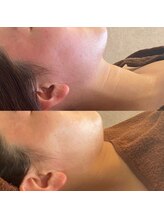 エンチャント(ENCHANT+)/ニキビケア、赤みにはレストセル