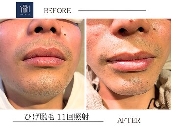 メンズメイド(Mens'Made)/before /after