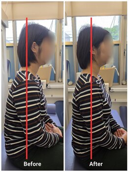 とばた整骨院/施術前後の姿勢変化