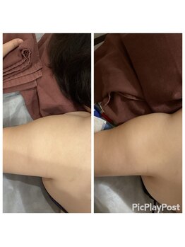 リッシュ(RICHE)/二の腕キャビゼロ