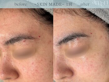 スキンラボアメリ(skin lab. ameri)/お悩み…ニキビ敏感肌ざらつき