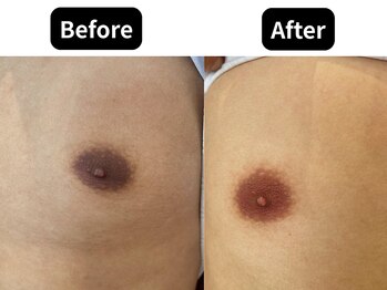 モンロー(MonroE+)/黒ずみ・くすみ・色素ケア