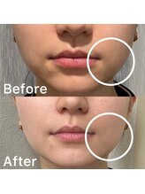 ビズビズ(bizz bizz)/オンダリフト小顔80kj小顔施術