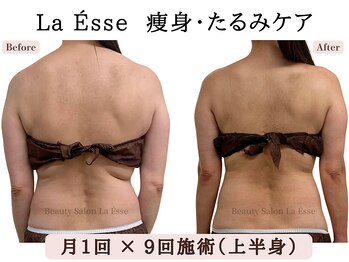 ラエッセ(La Esse)/背中を美しく パワーレメディ
