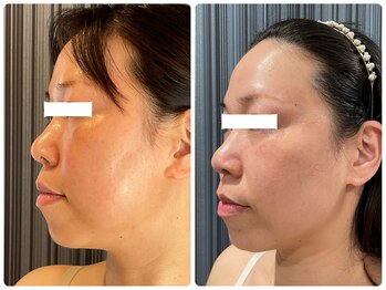 エクセレントビューティーサロン 艶(EN)/リベルハーブピーリンング